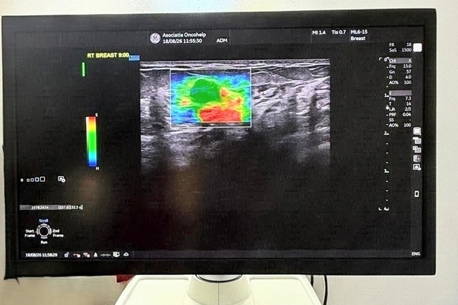 Investigatii mai precise pentru pacientii OncoHelp. Un ecograf de ultima generatie, cu elastografie, a intrat in dotarea centrului